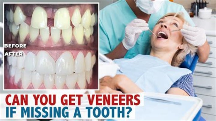 Can I get veneers if I have missing teeth?