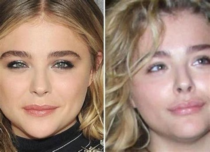 Chloe Grace Moretz's Plastic Surgery Journey: Unveiling Her Transformation