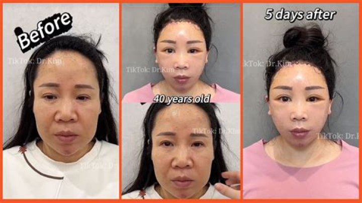 Evelyn Ha's Plastic Surgery Journey Revealed