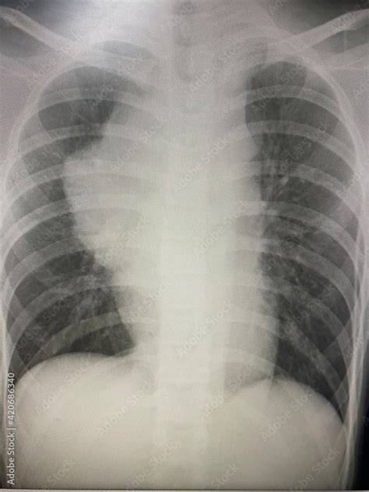 Will a chest xray show mold?